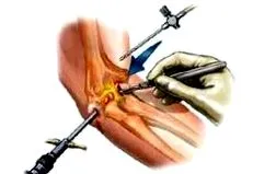 bursitis