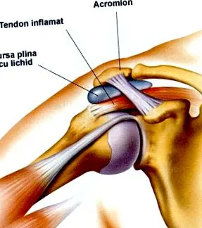bursitis