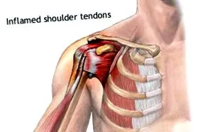 bursitis