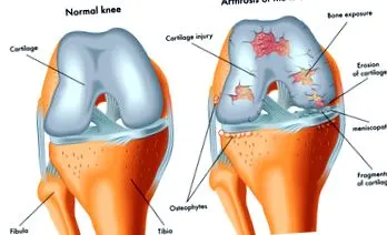 metatarsophalangealis osteoarthritisének