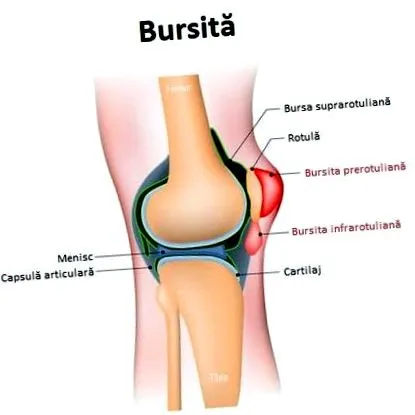 bursitisével kezelés