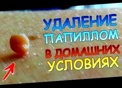 дипилоботријаза дифилоботријаза