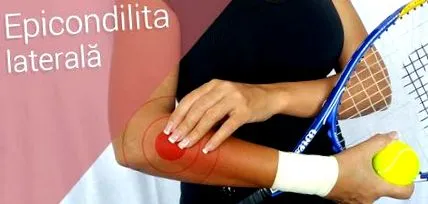 Oldalsó epicondylitis