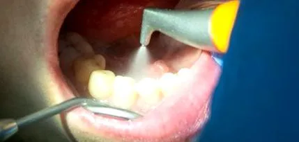 matyusdental kezelése