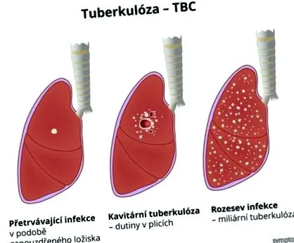 tuberculoza