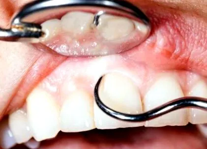 gingiilor retragerea