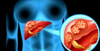 inițial cancer