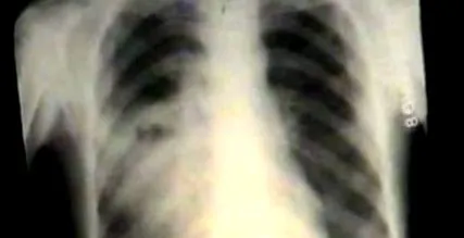 pulmonar