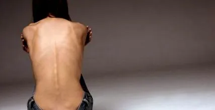 slovacii anorexia