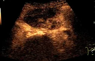 tumor