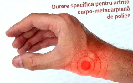 tudni vállfájásról