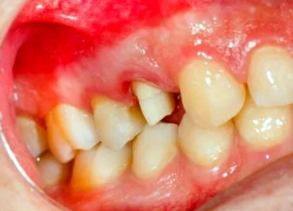 cauzează gingivale