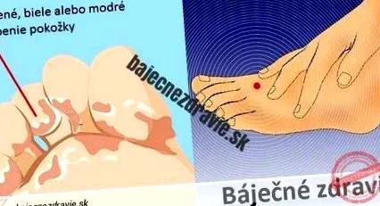 pajzsmirigyét cukorbetegségét
