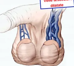 varicocele