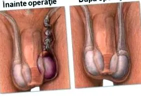 varicocele