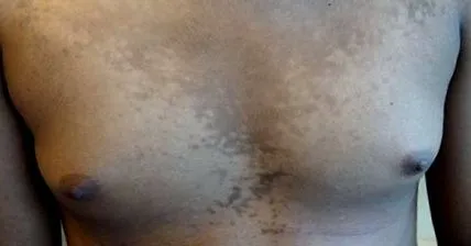 pikkelysömörből
