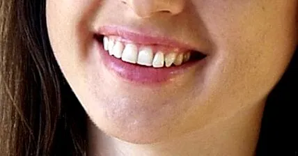 sângerarea gingiilor