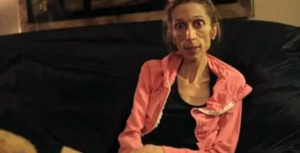 anorexic