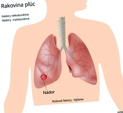 pulmonar simptome