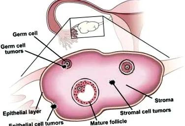 szerous cystadenoma