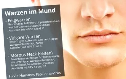 warzen hausmittel