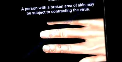 pinworms furazolidon pinwormok