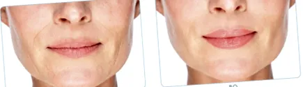 ronic dermal