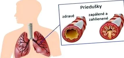 bronchitis