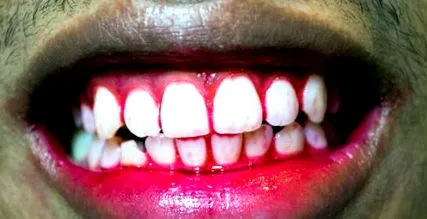 gingiile sângerarea