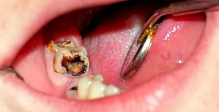 gingiile cariile