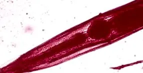 enterobiasis