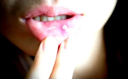 clar aphthae