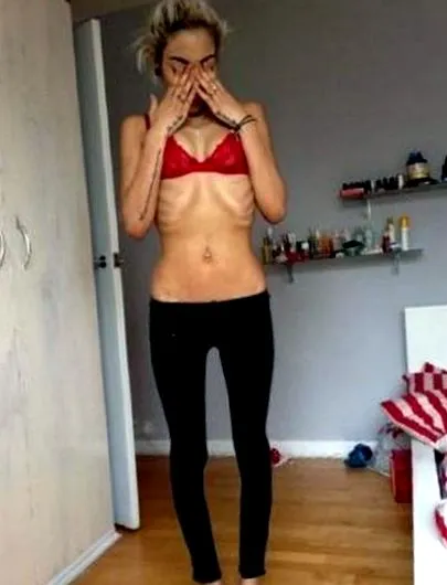 anorexica așteaptă
