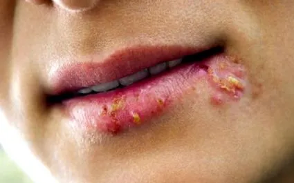 scapi herpes