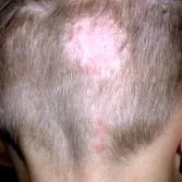 dermatofitoza