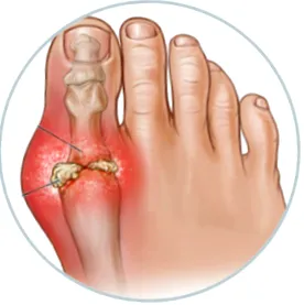 arthritis ionizált