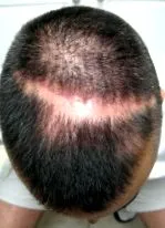 alopecie cicatricială