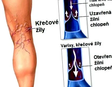 varicele