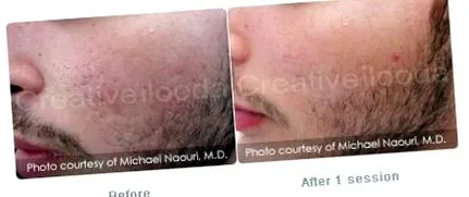 resurfacing estetică