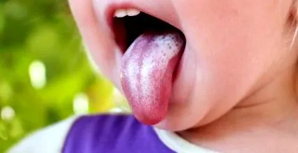 infecție cavitatea