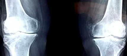 musculo-scheletice zbura obezitatea făcut