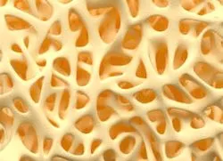 osteoporosis