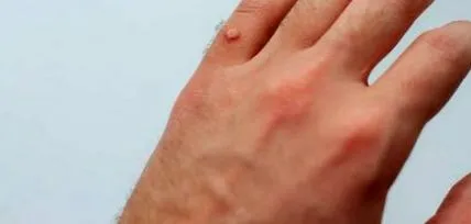 брадавиците брадавиците