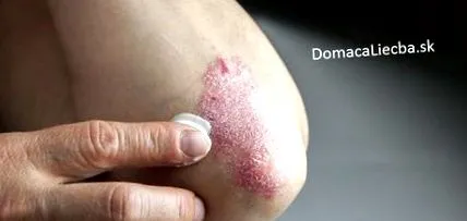 psoriazisul tratamentul