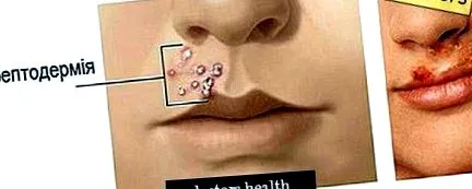 streptoderma
