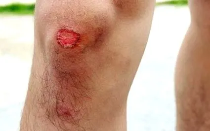 slabe ulcer