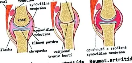 reumatism eficiente