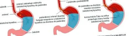 termen lung refluxul