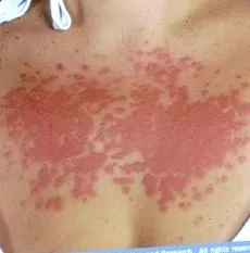 napra allergiák