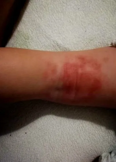 eczema distinge